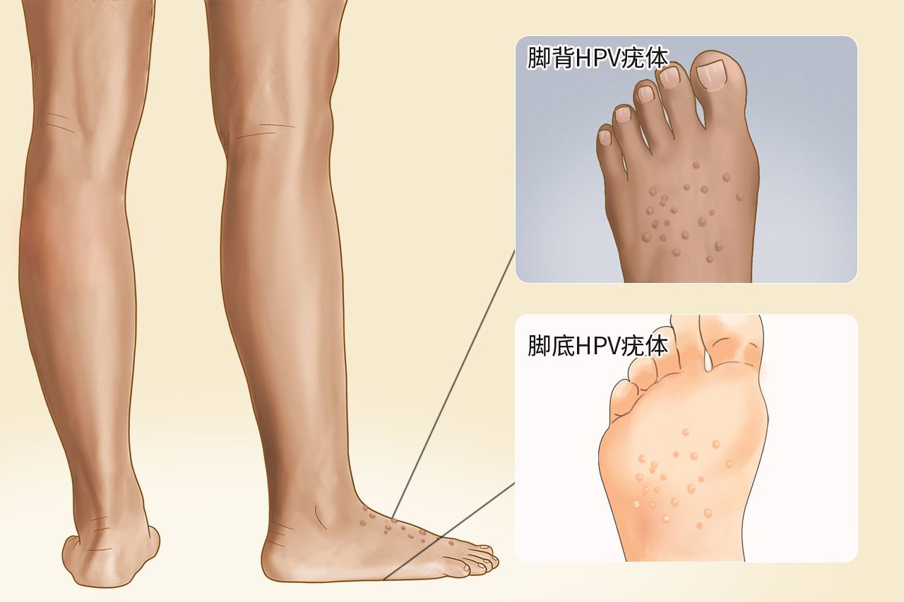 脚上hpv疣体长什么样子 脚上长hpv病毒和疣哪个先消失