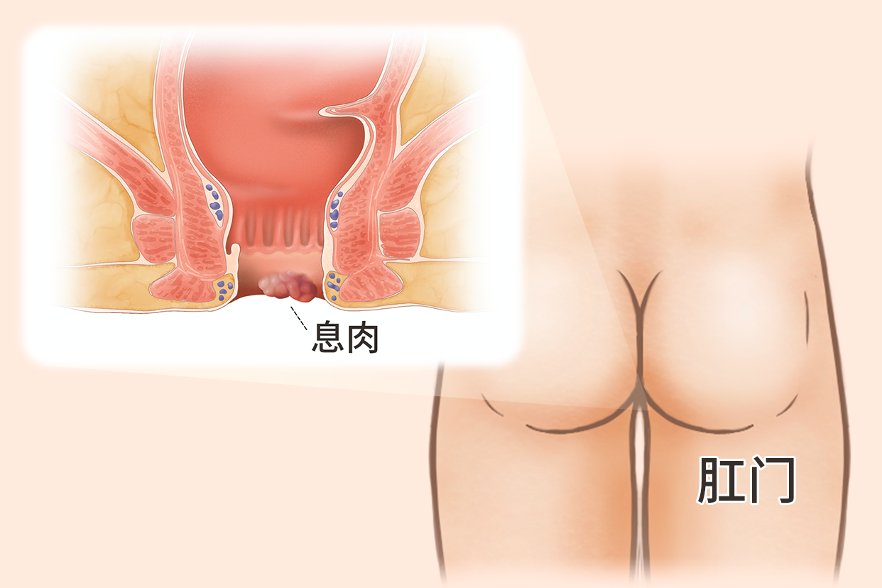 肛门肠息肉图片 肛门肠息肉的早期症状图片