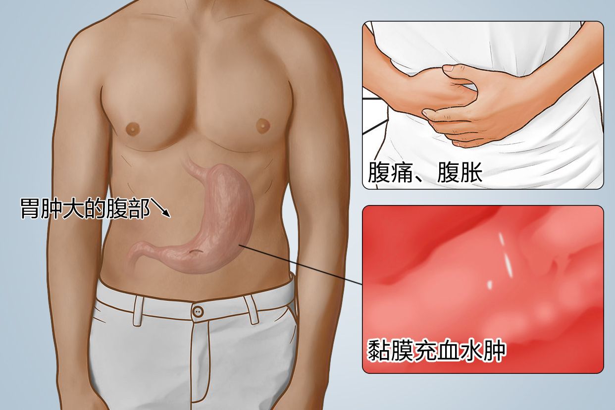 胃肿大的腹部图片（胃肿大怎么治疗）