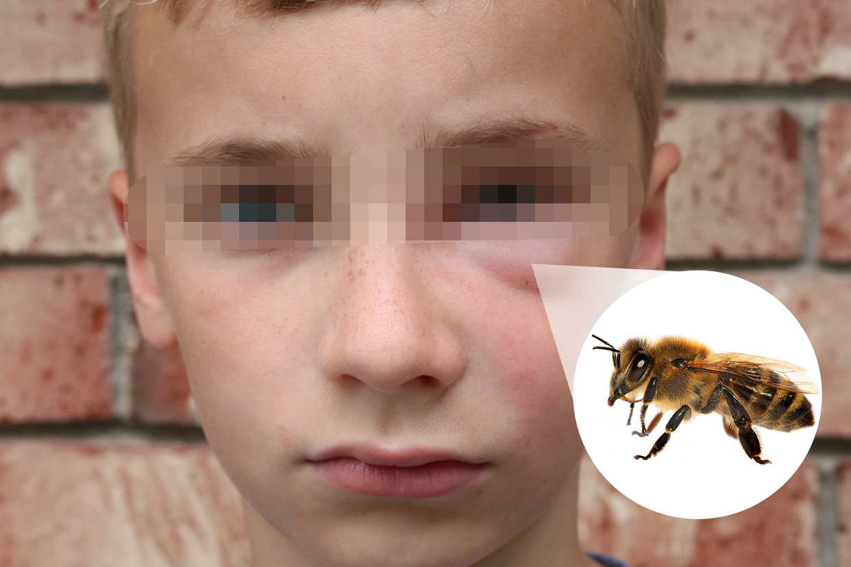 小孩被蜜蜂蛰了肿图片（小孩被蜜蜂蛰了红肿几天消除）
