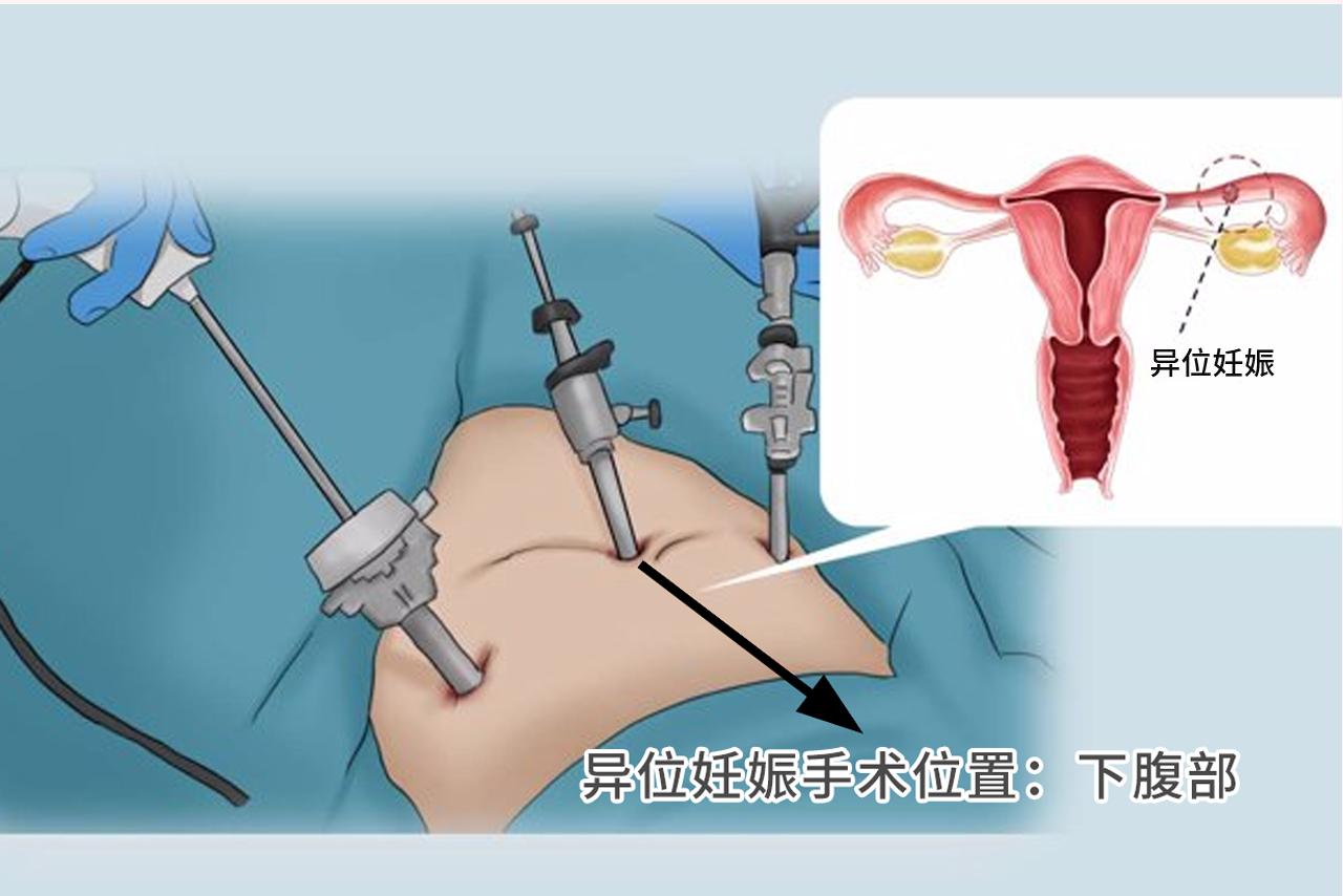 宫外孕手术在哪里开刀图（宫外孕手术在哪里开刀3d图片）