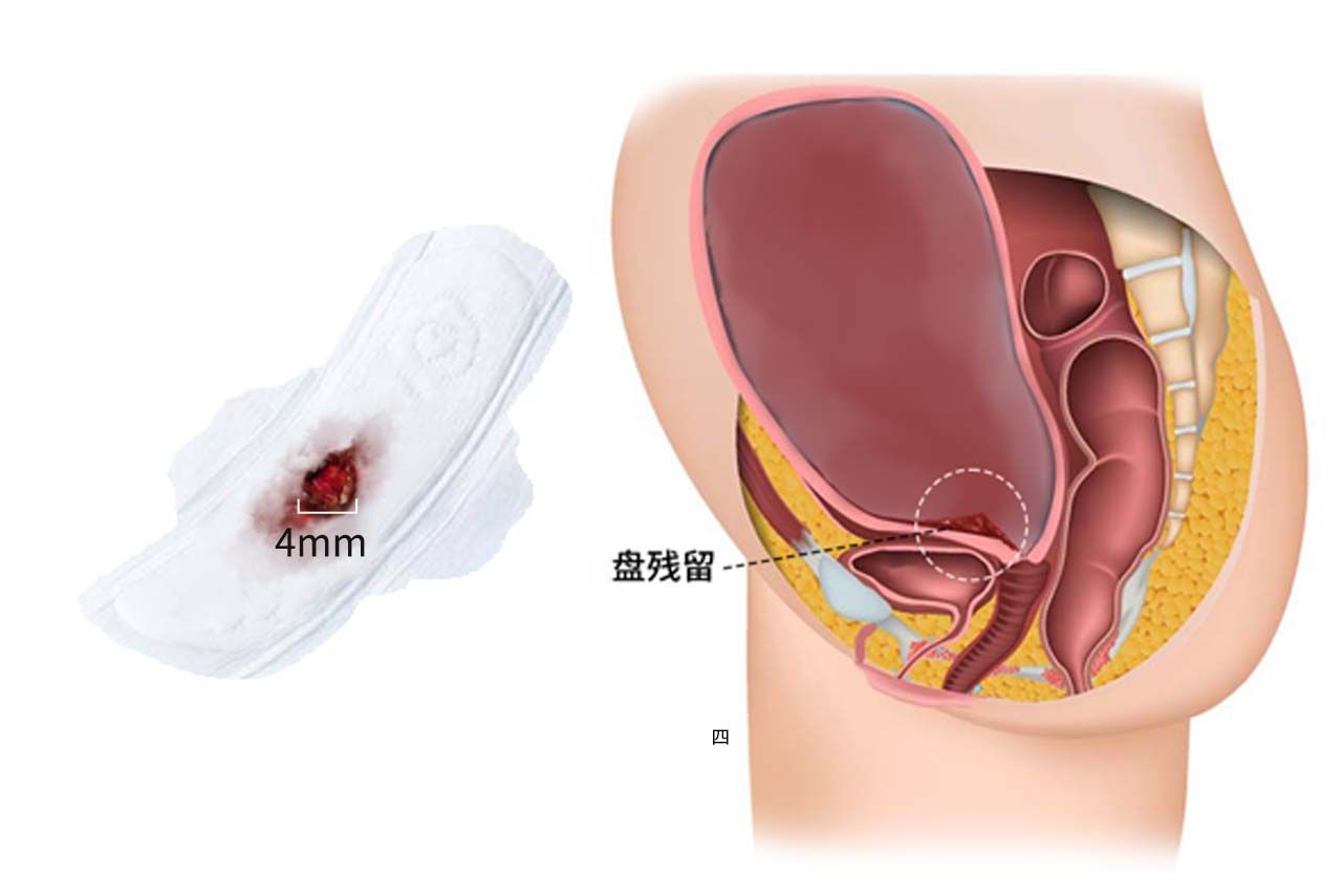 排出的残留物4mm的图片（排出的残留物是什么样子）