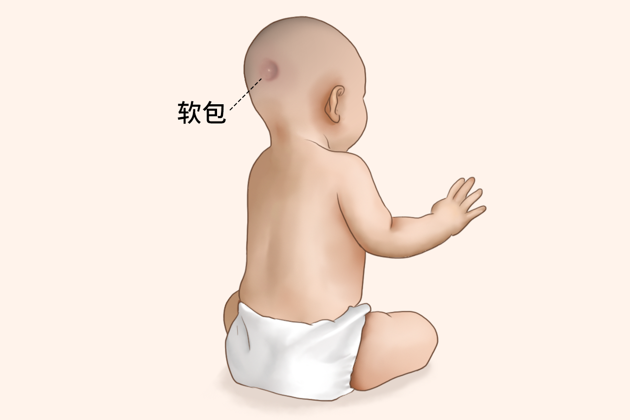 6个月婴儿后脑有个软包图片 六个月宝宝后脑勺有个包凸起软软的