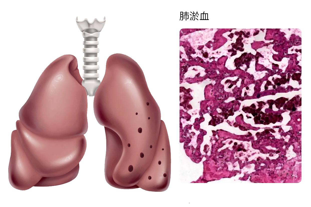 肺淤血图片（肺淤血图片及各部分结构）