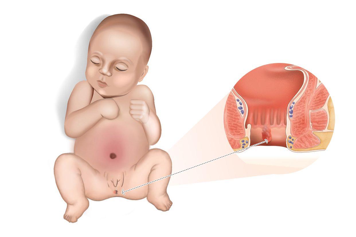 三个月婴儿肛门有肉疙瘩图片（三个月宝宝肛门那长了一颗硬是什么）