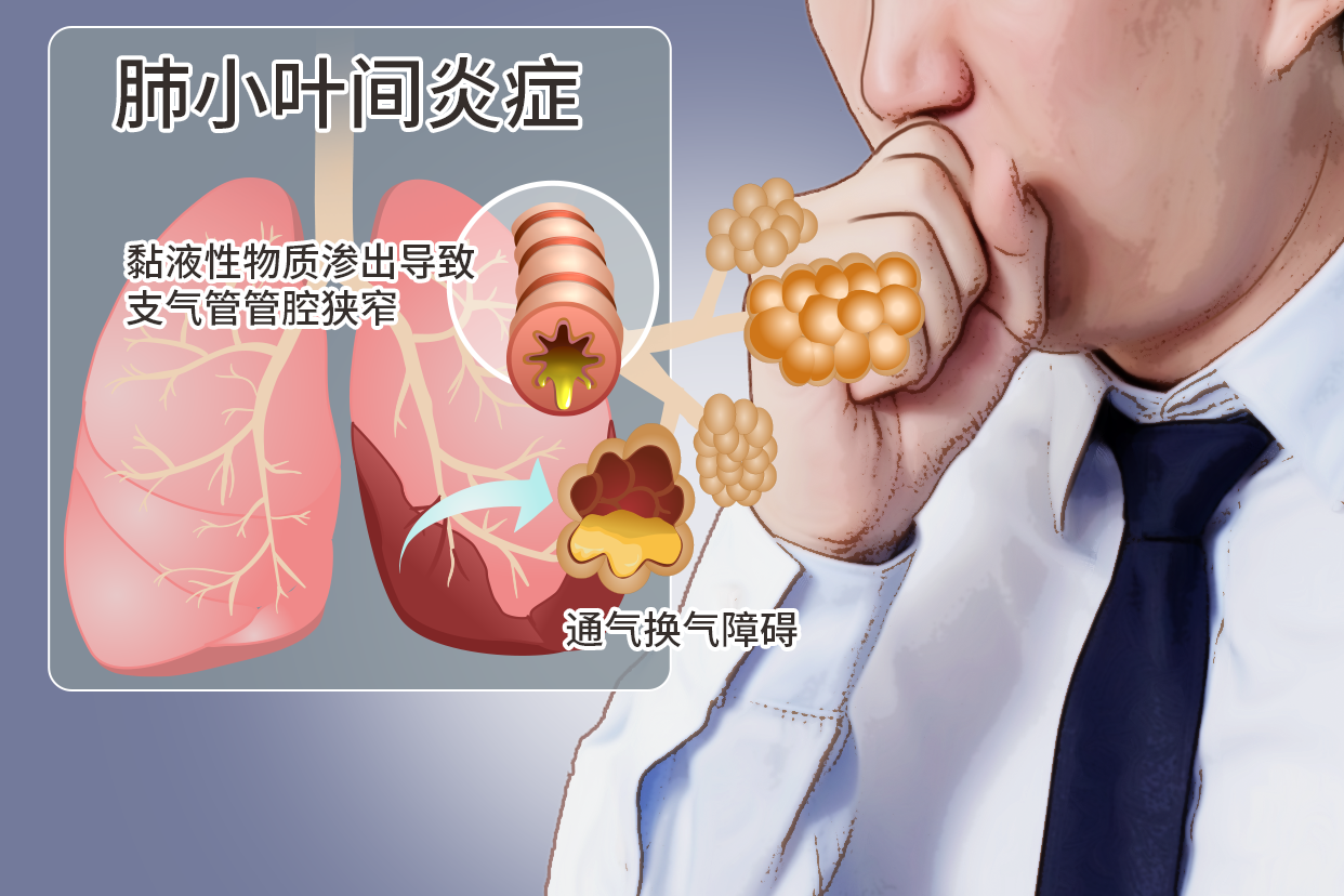 肺小叶间炎症图片高清 肺小叶炎症如何治疗