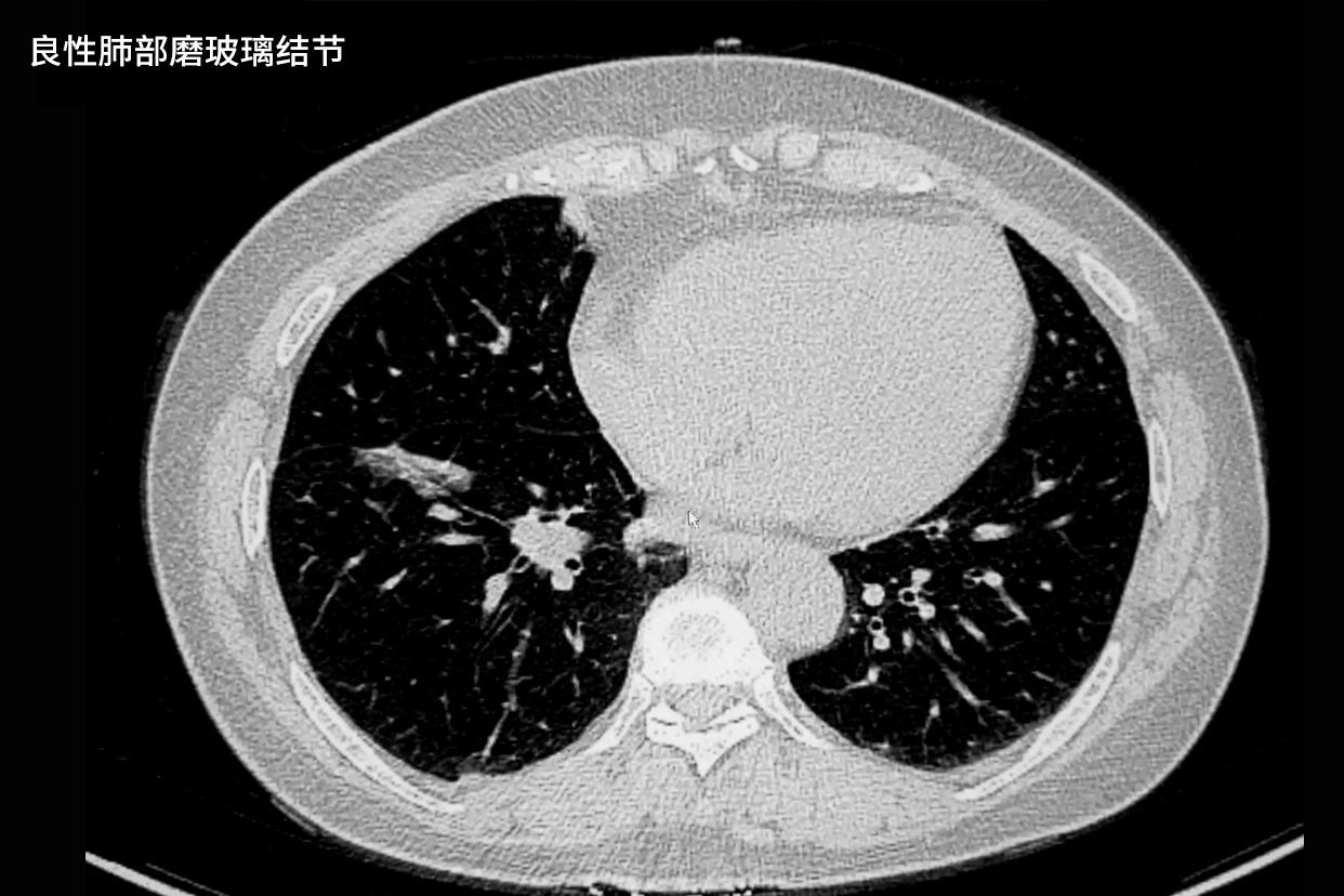 良性肺部磨玻璃结节影像图（肺良性磨玻璃ct表现）