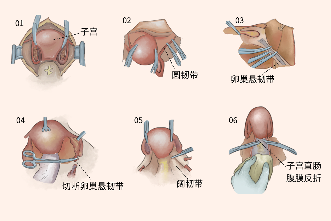子宫卵巢的切除手术示意图 子宫卵巢切除图片