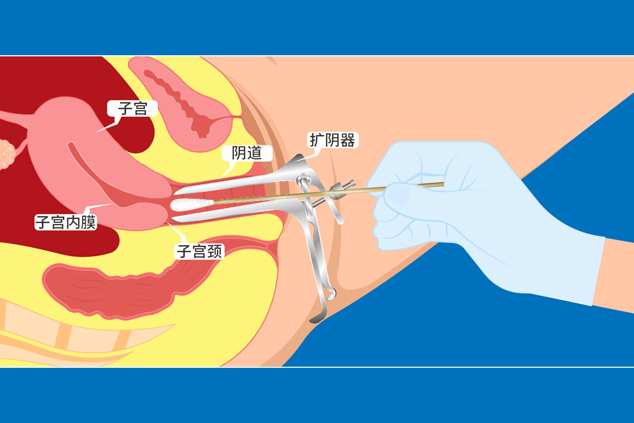 扩阴器阴道上药图片 扩阴器上药会不会有伤害