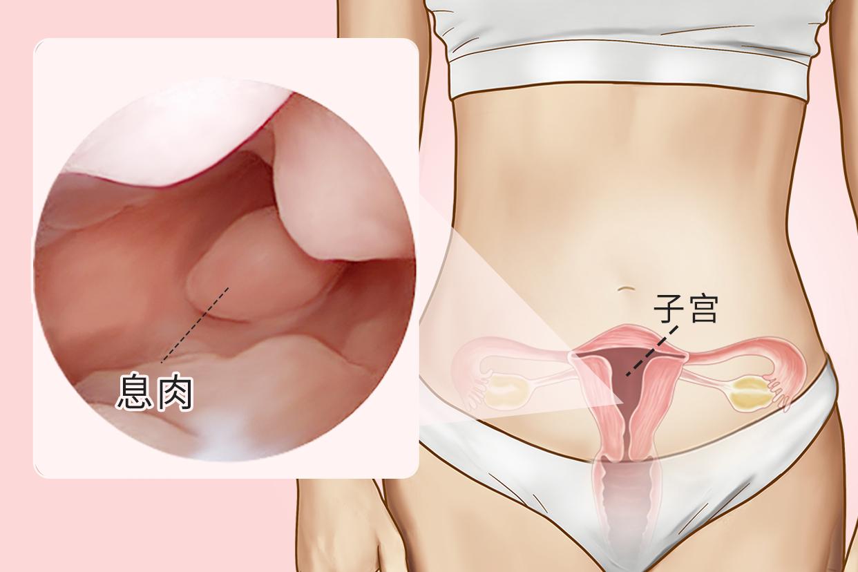 宫腔镜子宫内膜息肉良性图片（宫腔镜子宫内膜息肉的危险在哪里?）