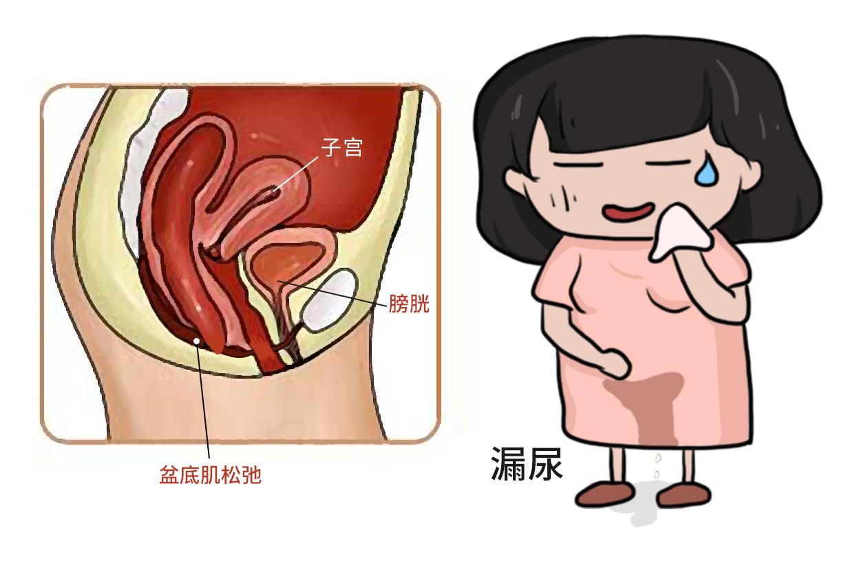 盆底肌松弛漏尿图片（盆底肌松弛漏尿如何治疗图片）