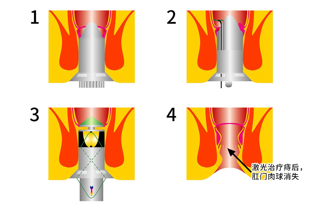 痔疮激光术后肛门口肉球图（刚刚做完激光痔疮手术现在特别疼）