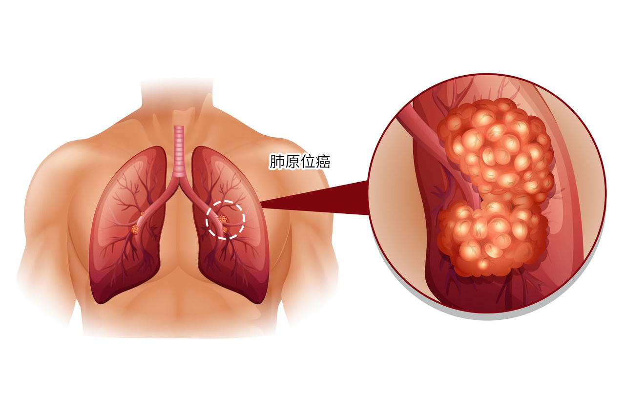 肺原位癌图（肺原位癌图片）