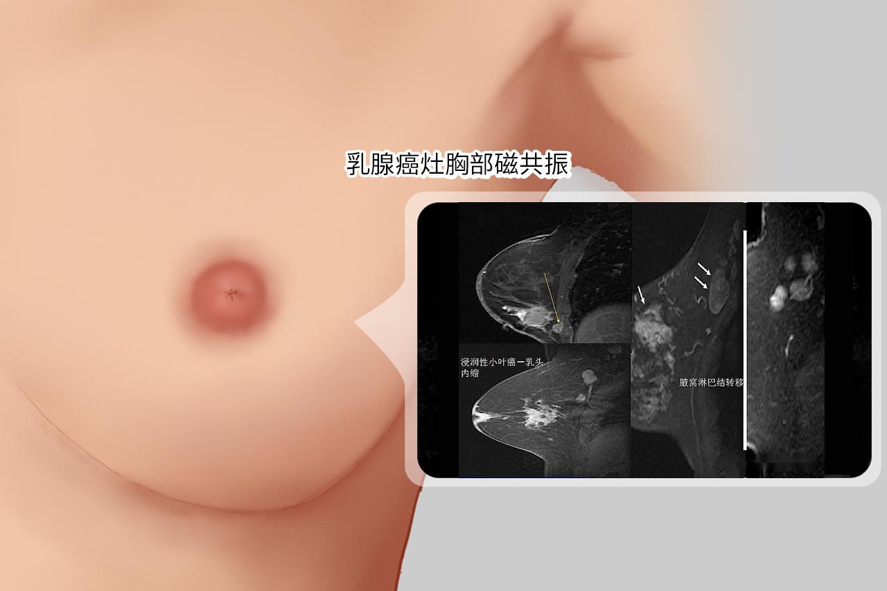 乳腺癌灶胸部磁共振图片 乳腺癌灶胸部磁共振图片高清