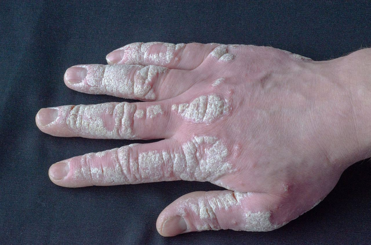 手指银屑病关节炎图片 手指银屑病关节炎图片和症状