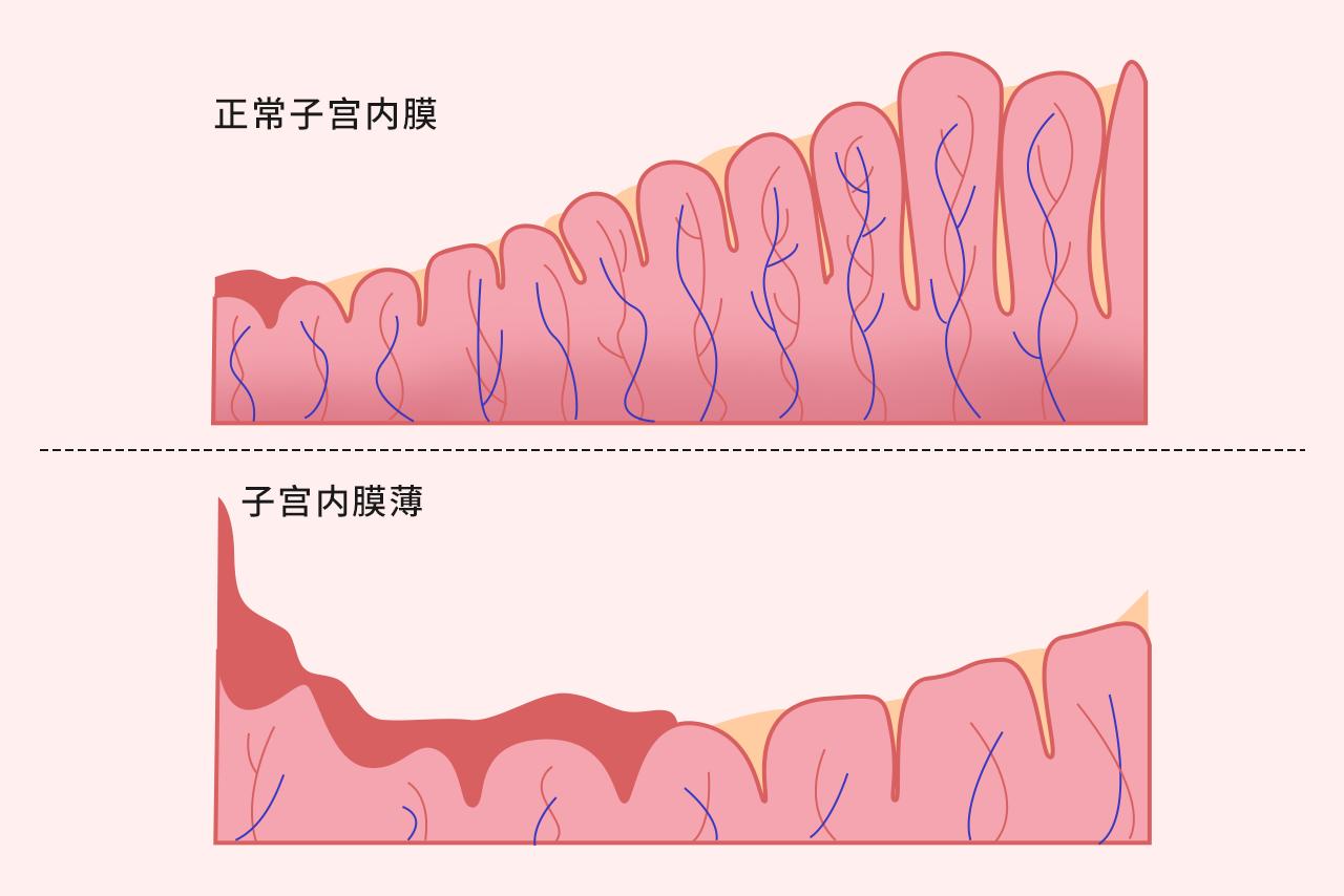 子宫内膜薄图片 子宫内膜薄的临床表现