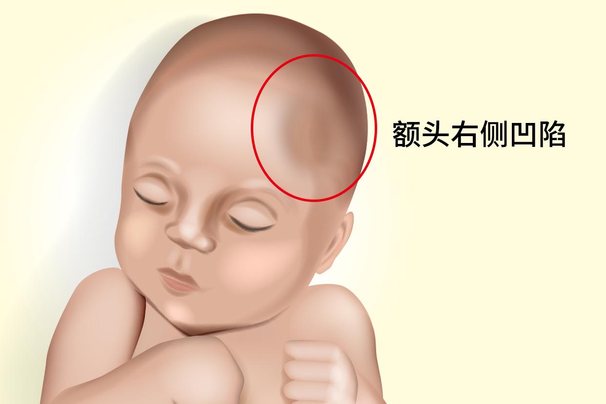 宝宝额头右侧凹陷图片 婴儿额头右侧凹陷