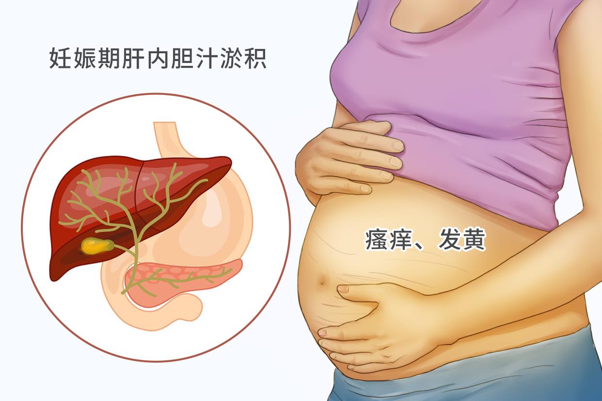 孕妇胆淤和湿疹的图片 孕妇胆淤和湿疹的图片对比