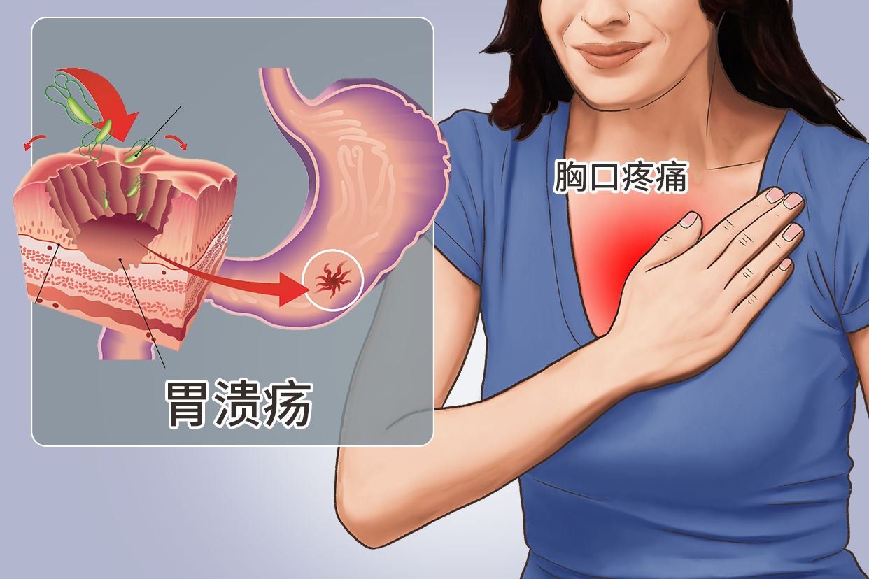 胃溃疡胸口疼位置图（胃溃疡感觉胸前不舒服）