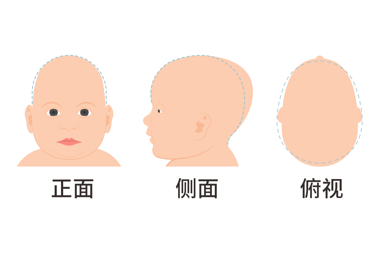婴儿头两侧有凹陷怎么回事图片 婴儿头部两侧凹陷怎么回事