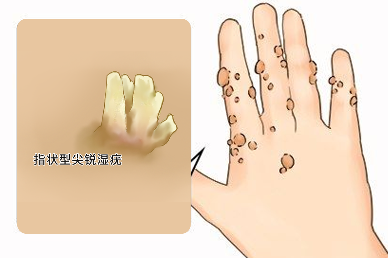 指状尖锐湿疣图片（指状疣怎样治疗）