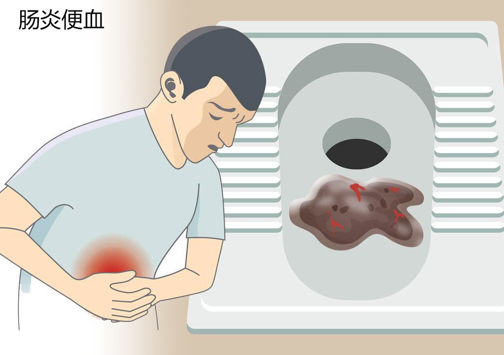 肠炎便血图片 肠炎便血图片大便