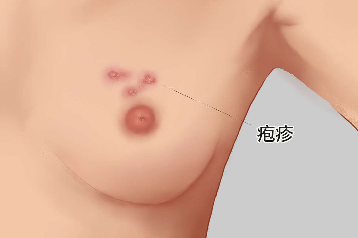 女性乳房长疱疹图样（女人乳房上长疱疹是什么样的）