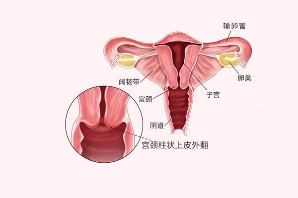 宫颈口外翻是怎么回事图片