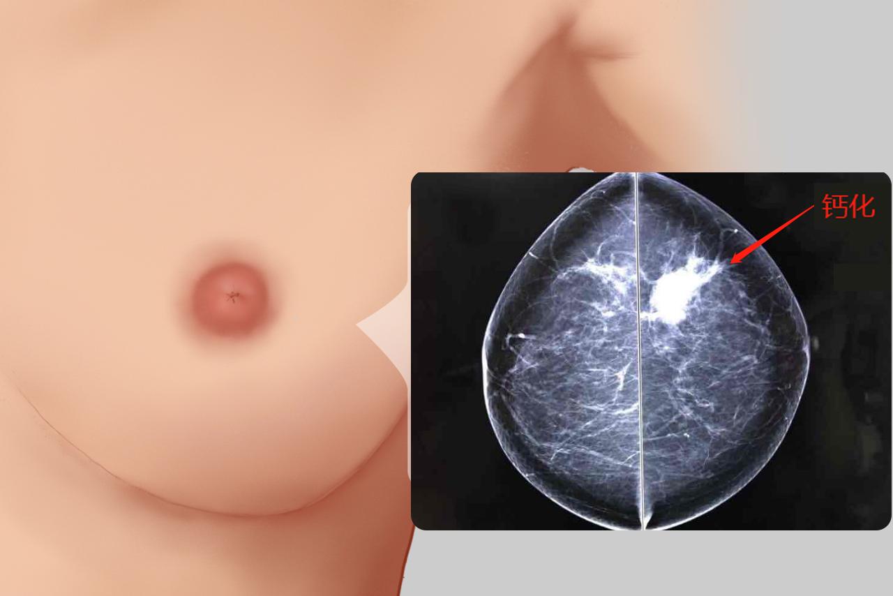 乳腺癌钙化图片