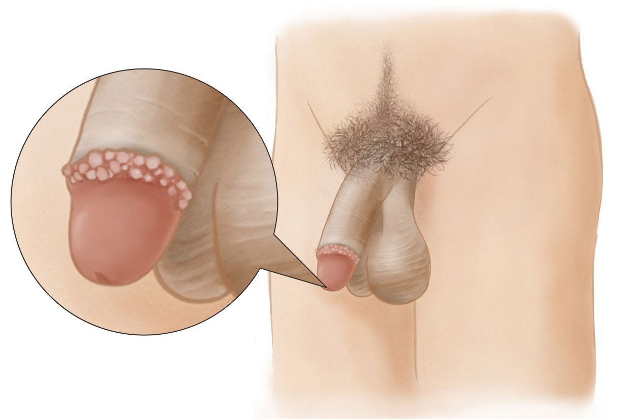 尖锐湿疣感染，小便位置的图片
