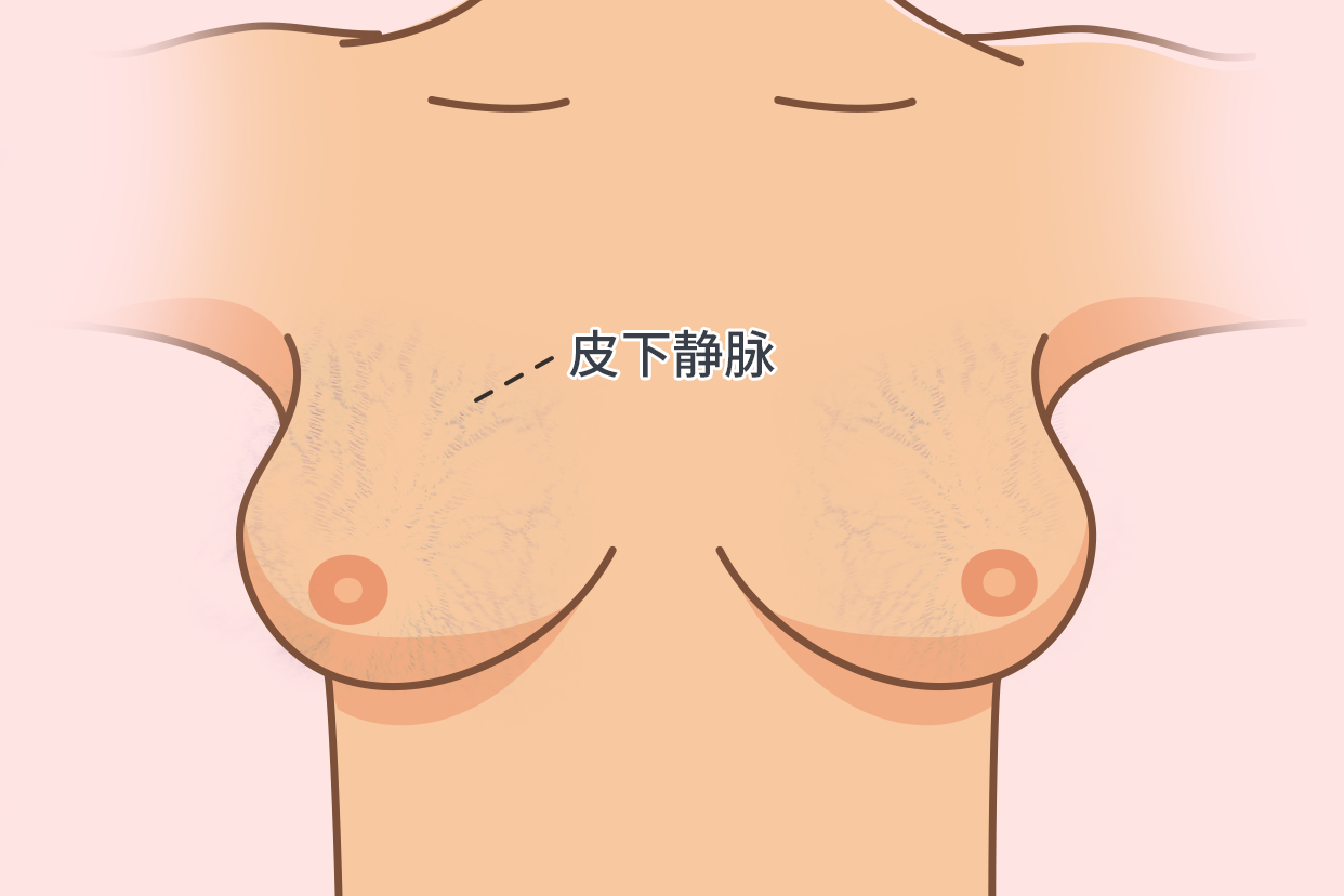 乳房皮下静脉图片