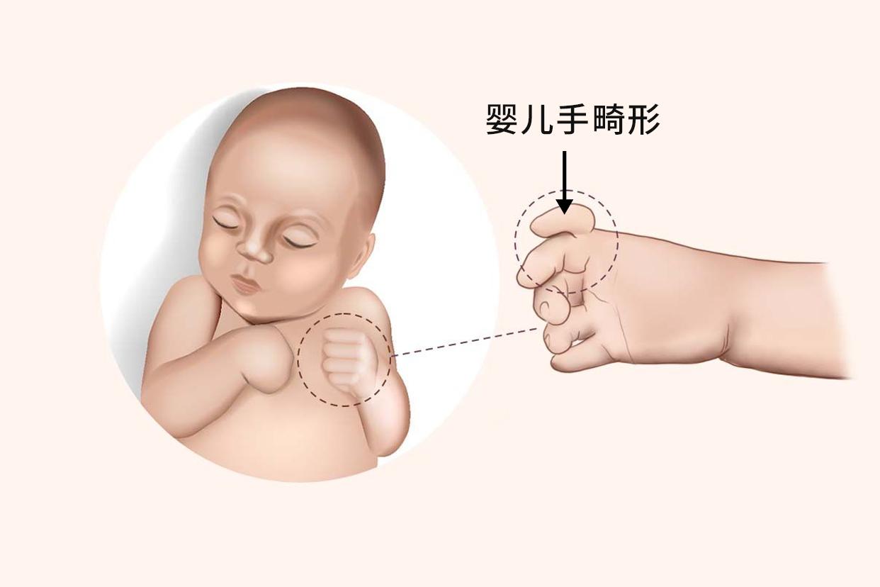 婴儿手畸形图片