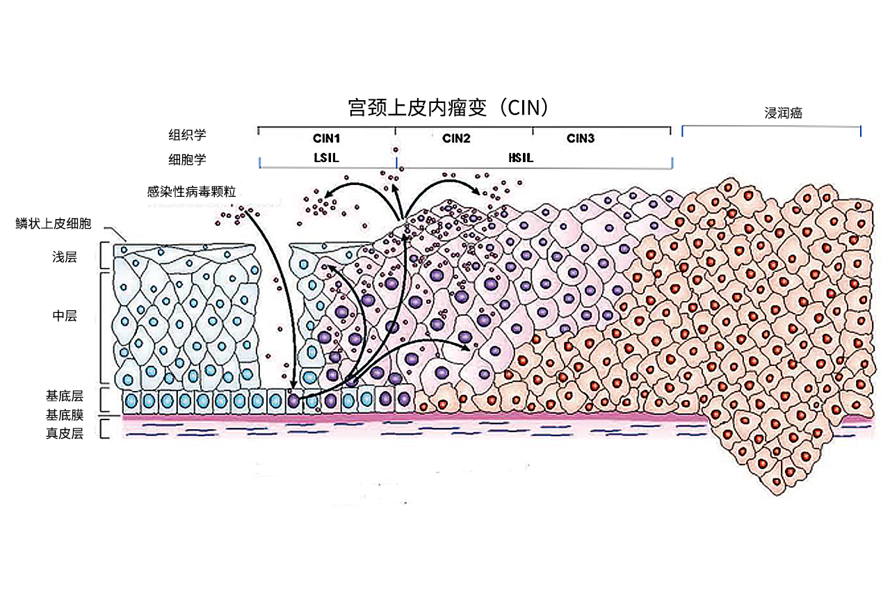 宫颈cin分级图片