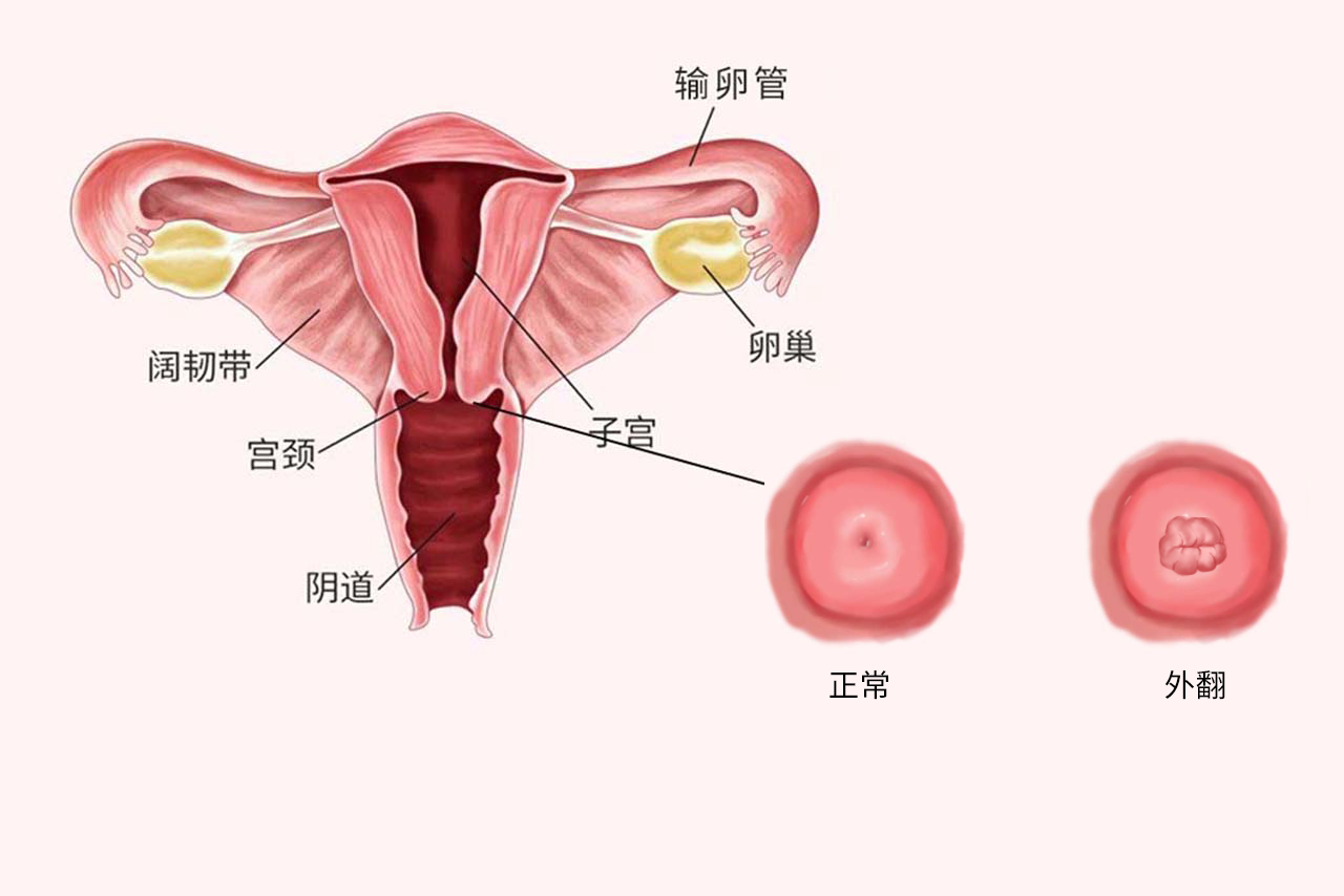 宫颈外翻图片