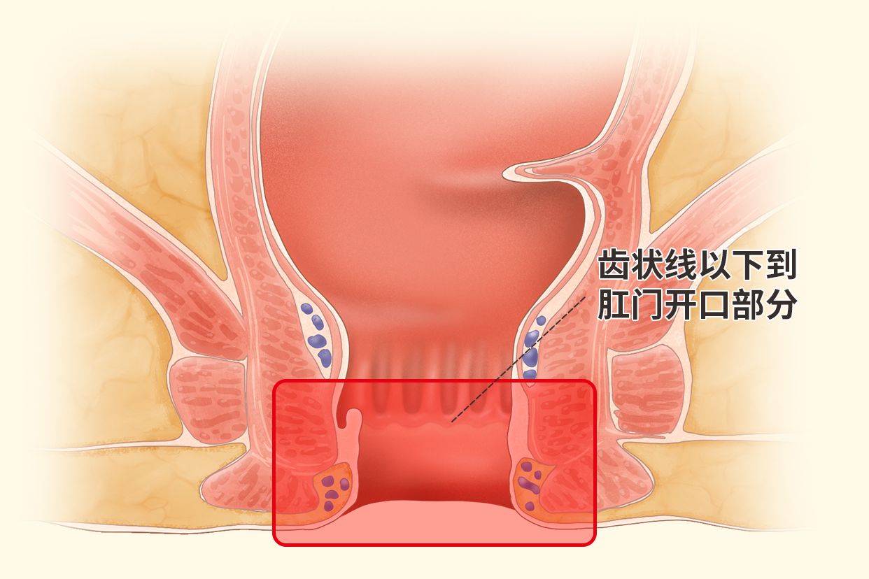 肛管癌位置图片