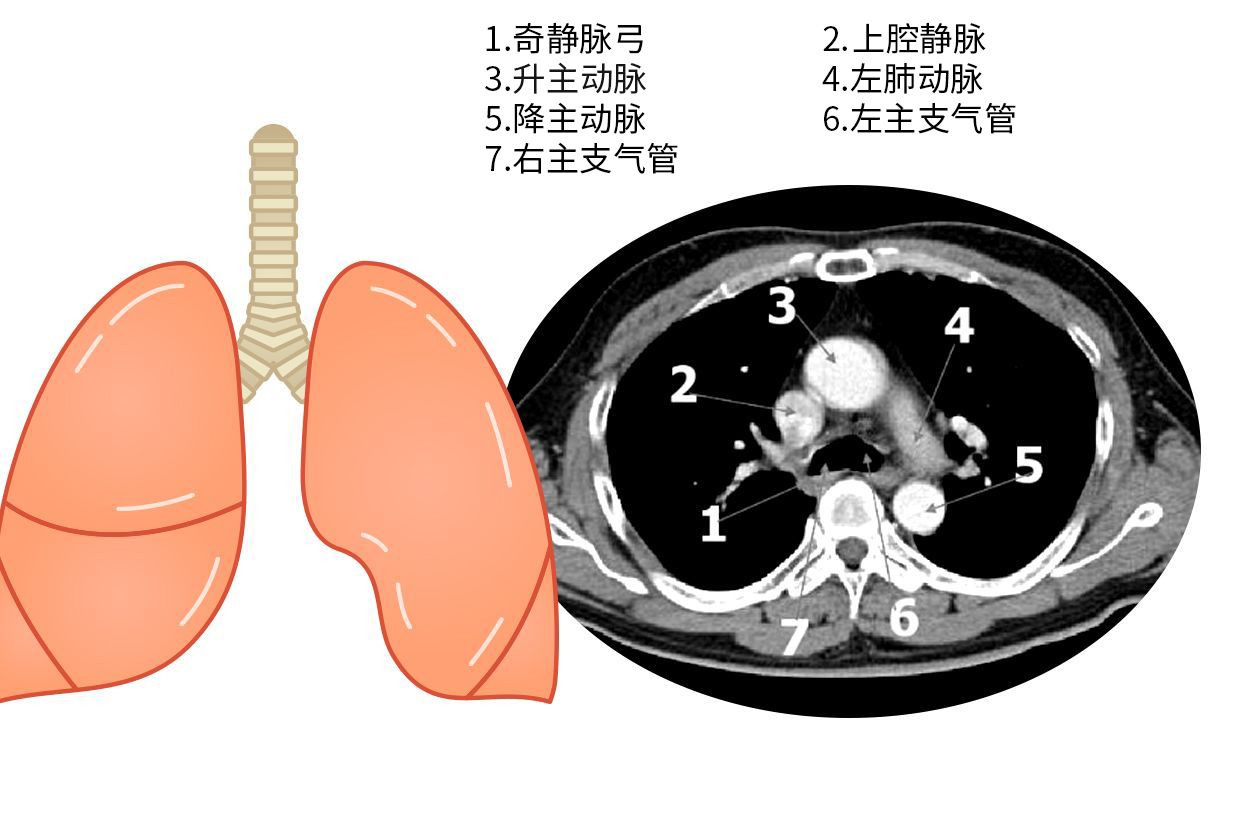 主动脉肺动脉窗图片