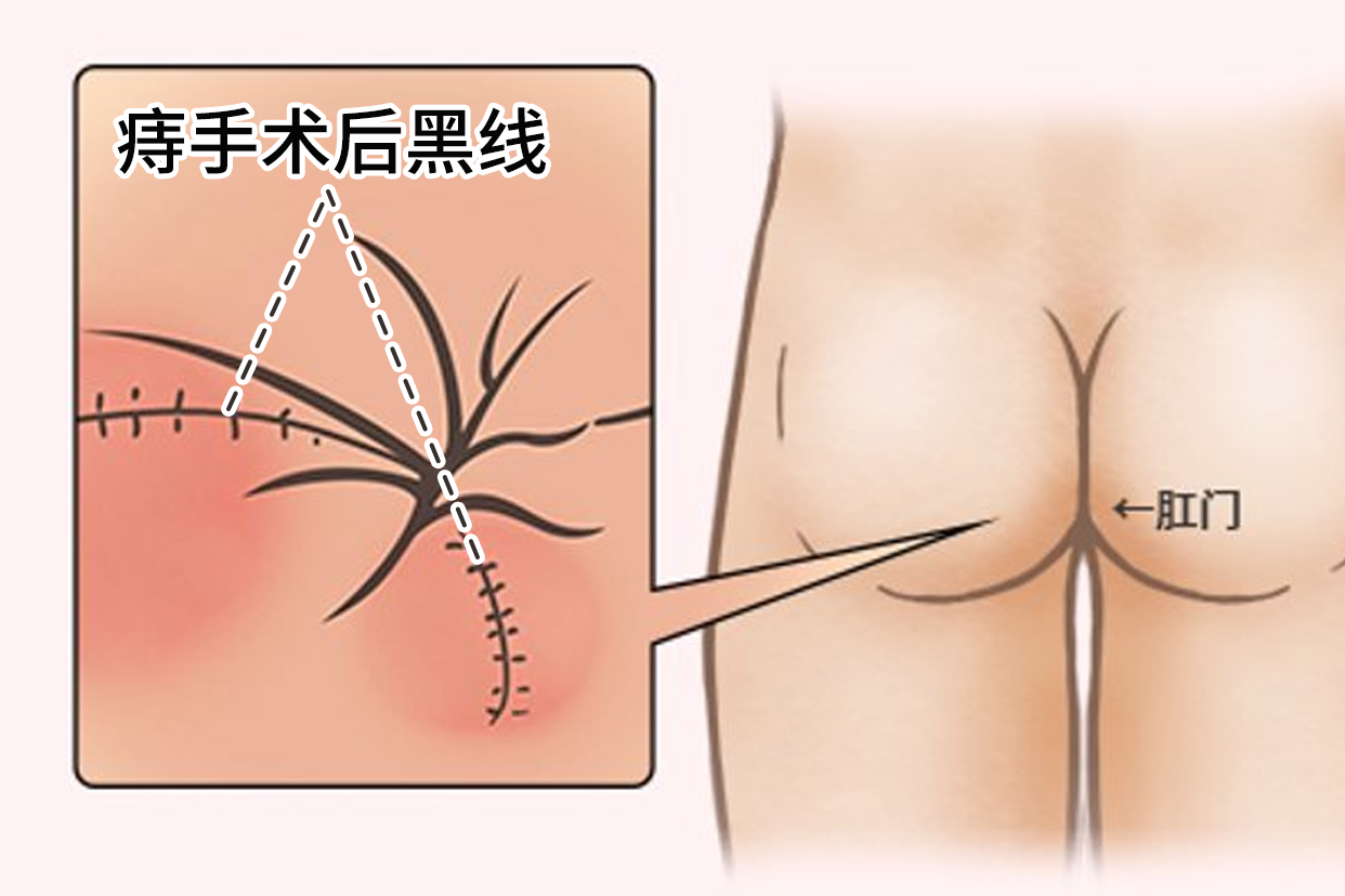 痔疮手术后黑线图片