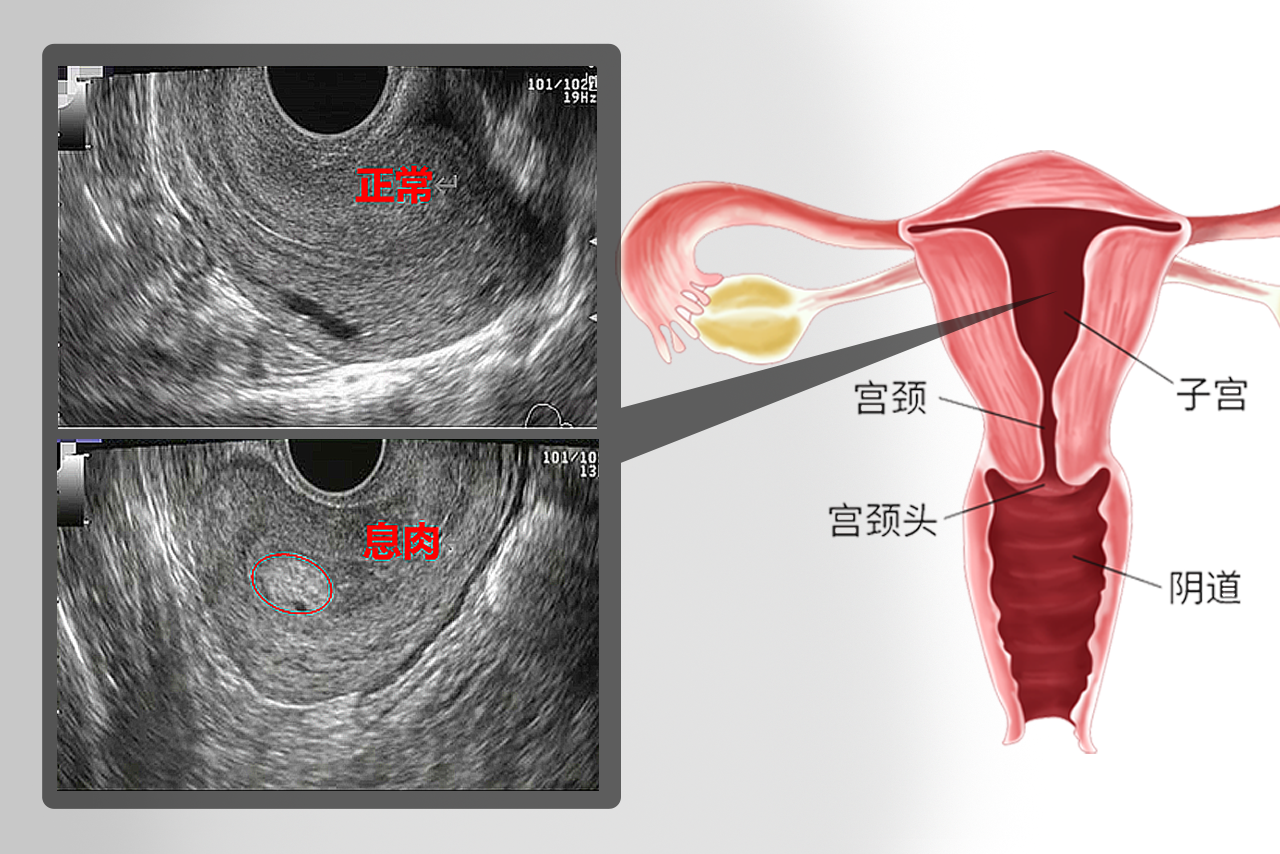 子宫息肉的b超图像